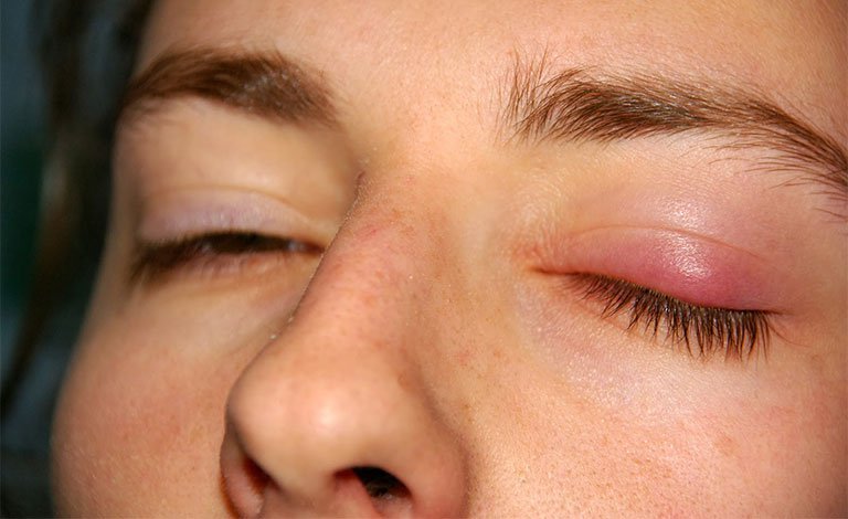 Sưng một bên mắt khi đang dùng thuốc trị viêm họng có sao không?