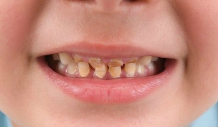 Bổ sung vitamin C cho trẻ giúp hạn chế tình trạng mòn men răng