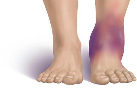 lật cổ chân và cách điều trị