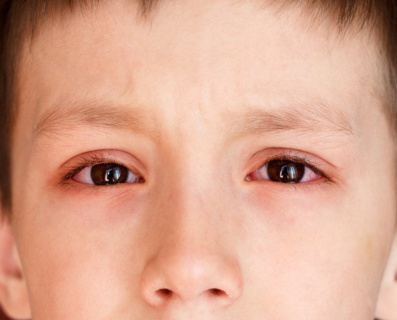 Trẻ bị viêm giác mạc dị ứng điều trị dứt điểm thế nào?