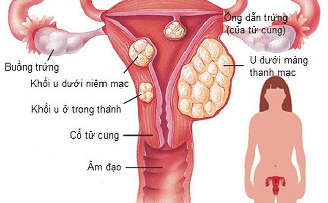 Nữ giới cắt u xơ tử cung, đau rát âm đạo điều trị như thế nào?
