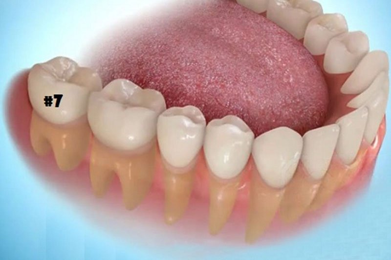 Mặt nhai răng số 7 có chút rãnh kẽ đen nên làm gì?