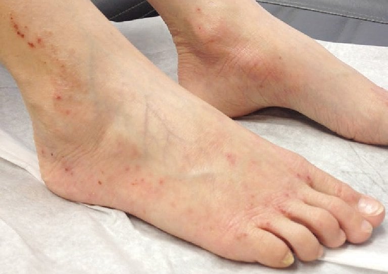 Nam giới nổi mụn đỏ, mụn nước trên mu bàn chân nguyên nhân là gì?