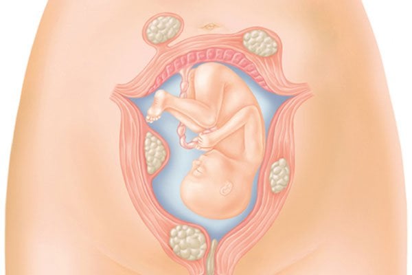 Điều trị nhân xơ tử cung khi mang thai 5 tuần như thế nào?