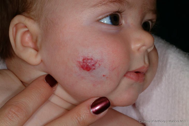 Mụn máu trên mặt ở trẻ điều trị hết được không?
