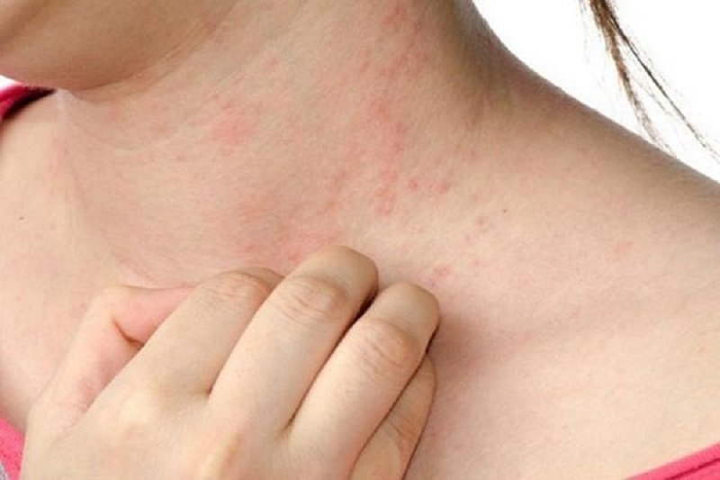 Nữ giới sốt, mẩn đỏ trên da là dấu hiệu bệnh gì?