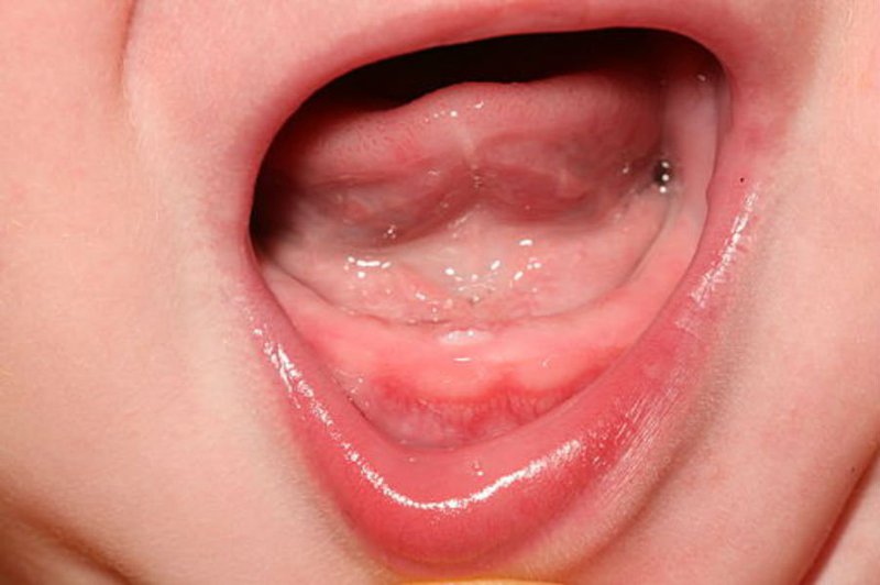 Bé gái được 5 tháng đã mọc răng có vấn đề gì không?