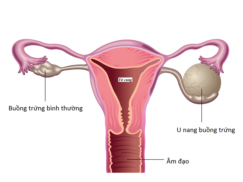 Mắc u nang buồng trứng kèm đau vùng dưới bụng có nguy hiểm không?