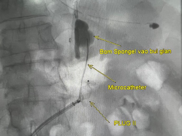 Chặn shunt vị - thận với microcatheter
