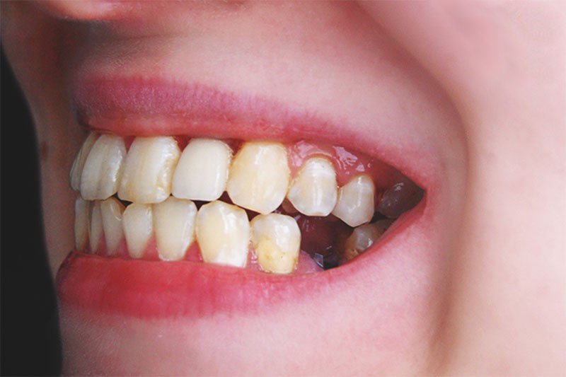 Người bị mất răng có niềng răng được không?