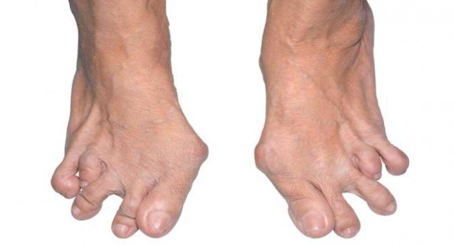 viêm khớp dạng thấp ở bàn chân