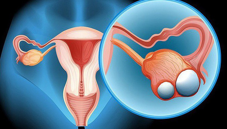 Nữ giới u bì buồng trứng tái điều trị như thế nào?