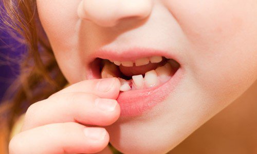 Nữ giới răng lung lay nên làm gì?