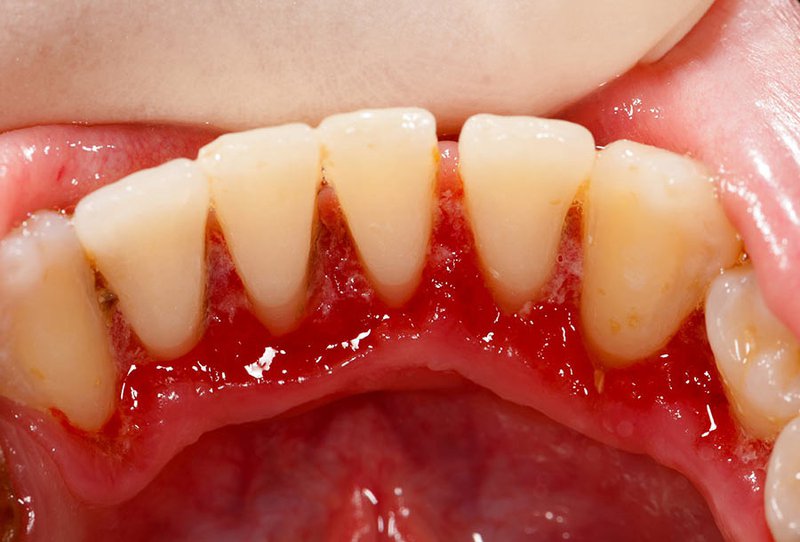 Viêm quanh chân răng không đau nhức điều trị tại nhà được không?