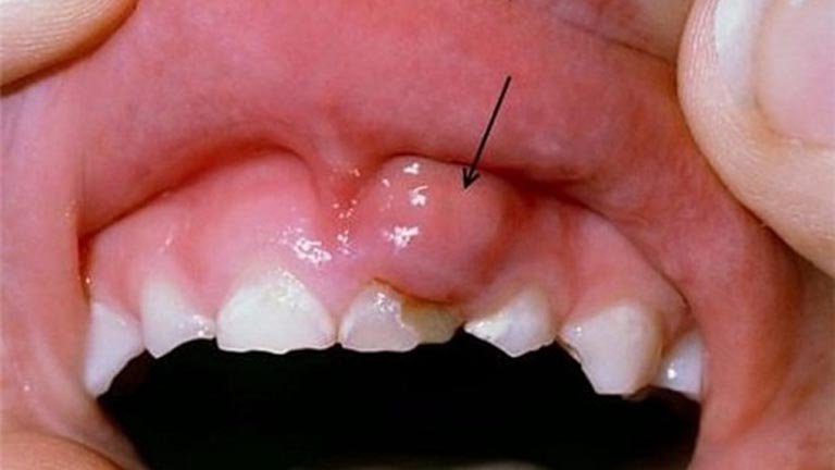 Sưng nướu kèm đau nhức chân răng khắc phục thế nào?