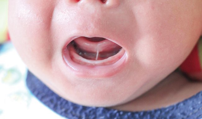 Trẻ 3 tháng bị dính thắng lưỡi độ 4 có phẫu thuật được không?