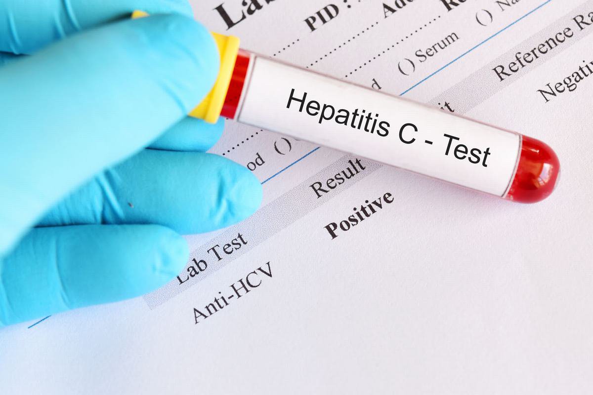 Phương pháp điều trị sau khi Test HCV dương tính