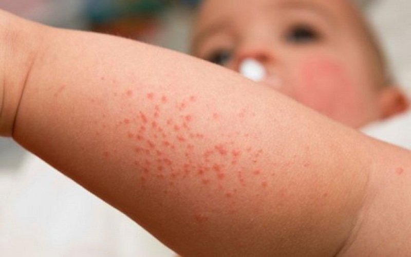 Trẻ bị xuất huyết giảm tiểu cầu kèm nổi vết bầm da có sao không?