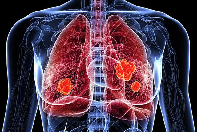 Điều trị ung thư phổi bằng phương pháp miễn dịch như thế nào?