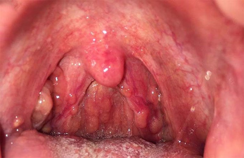 Nữ giới viêm họng hạt điều trị như thế nào?