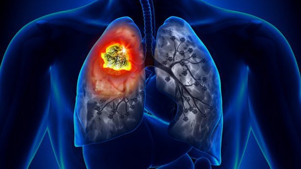 Cách điều trị ung thư thùy giữa phổi di căn cột sống giai đoạn 4?