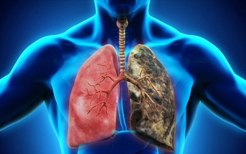 Ung thư phổi và những điều cần biết