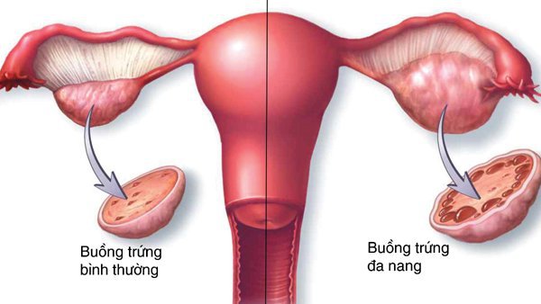 Đa nang buồng trứng kèm viêm cổ tử cung có thể mang thai không?