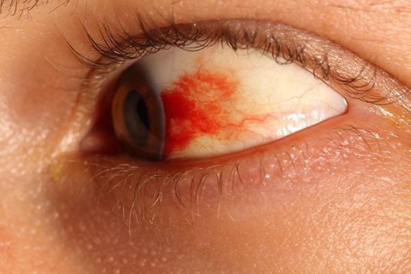 Đỏ hai mắt kèm đuôi mắt nổi gân đỏ là dấu hiệu bệnh gì?