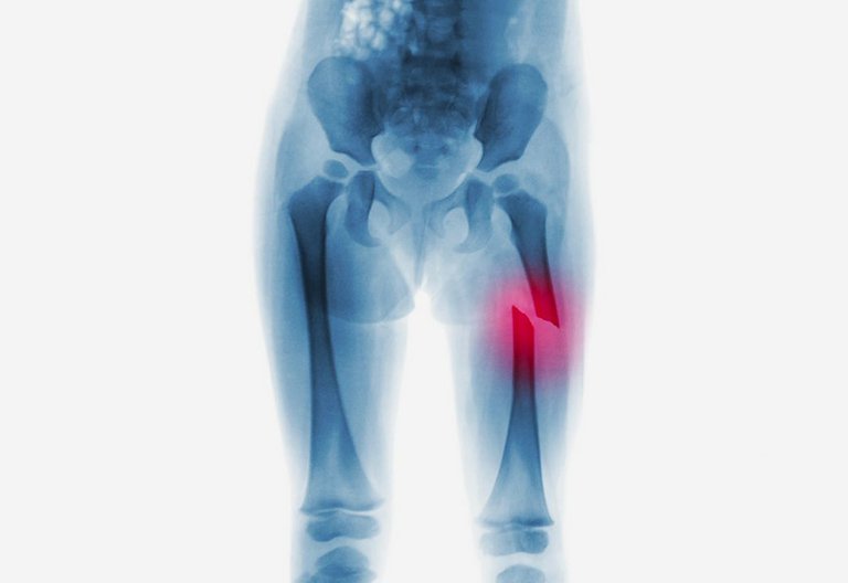 Gãy xương đùi không phẫu thuật sau bao lâu có thể hồi phục?