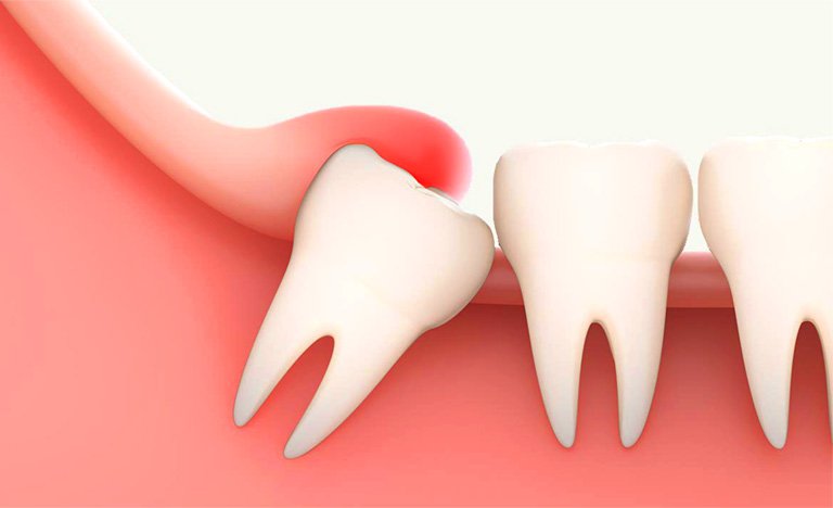 Đau nhức răng khôn do lợi trùm nhổ được không?