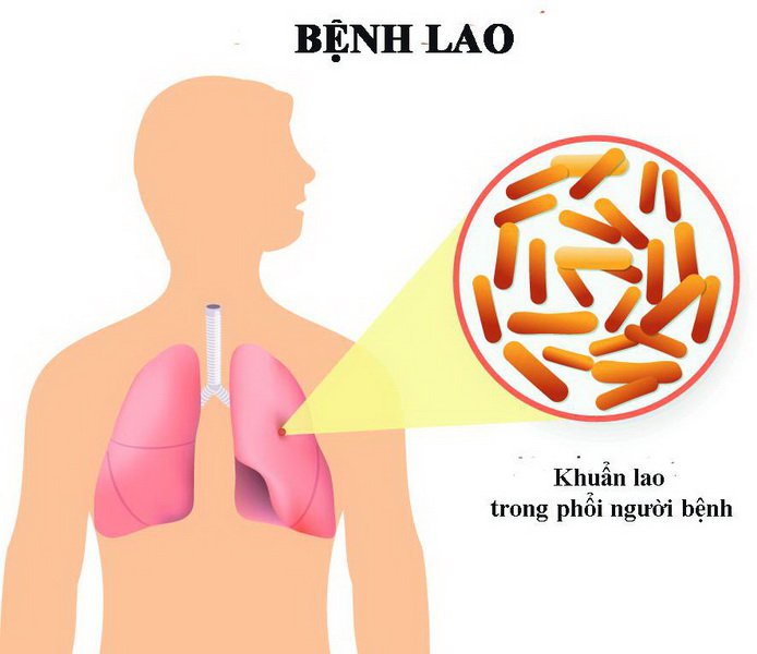 triệu chứng của bệnh lao phổi tái phát