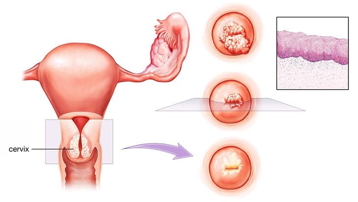 Viêm cổ tử cung tái tạo là bệnh lý phụ khoa cần được phát hiện sớm