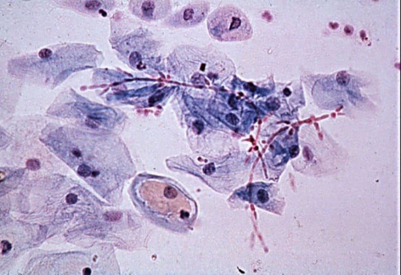 Mắc viêm tạp khuẩn