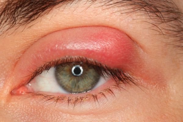 Mí mắt còn sưng sau tiểu phẫu chắp mắt có sao không?