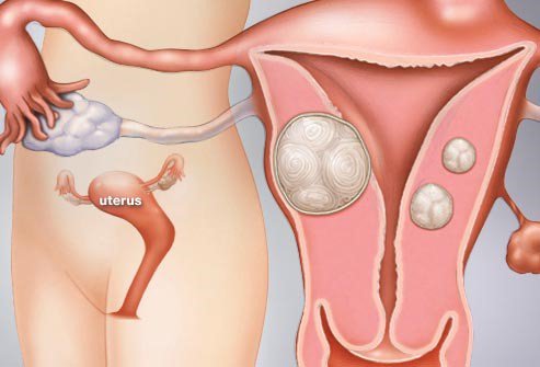 Điều trị u nang thành mạng tử cung như thế nào?