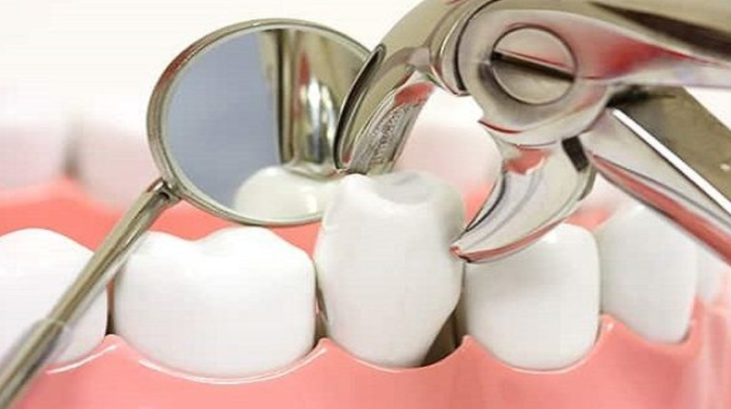 nhổ răng giảm tuổi thọ