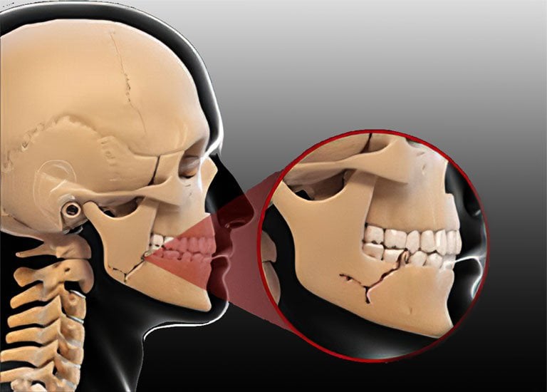 Bài tập phục hồi sau gãy xương hàm