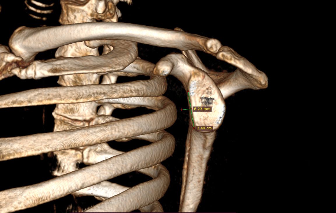 Hình 5: Hình ảnh CT 3D trước mổ được dựng hình và đo các thông số khuyết xương của ổ chảo