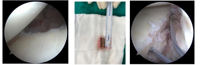 Hình 6: ảnh thực tế trong quá trình phẫu thuật: chuẩn bị mảnh ghép xương, khoan đóng neo để cố định mảnh ghép và chuẩn bị đưa mảnh ghép vào khớp vai