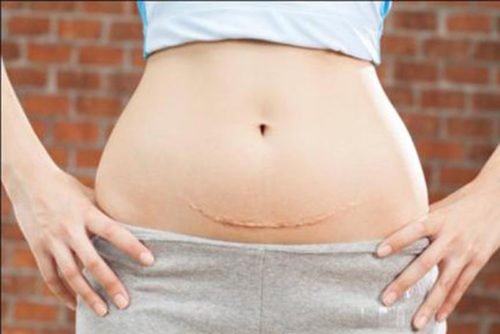 Phương pháp tránh thai sau sinh mổ