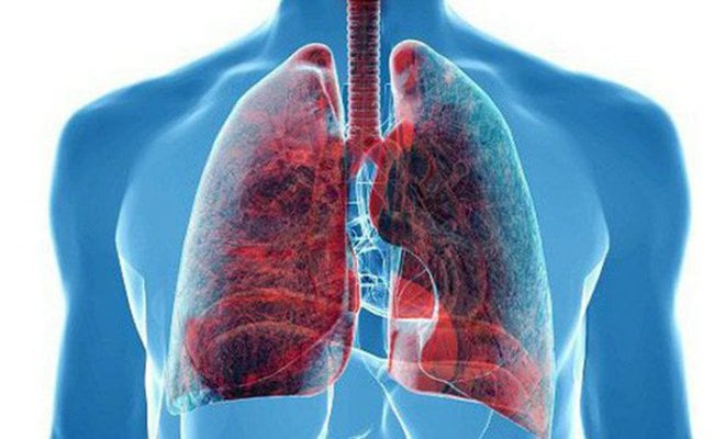 Ung thư phổi tế bào nhỏ di căn xương cánh chậu điều trị thế nào?