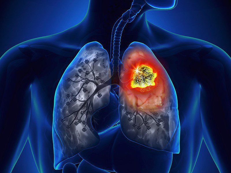 Ung thư phổi giai đoạn cuối di căn hạch điều trị thế nào?