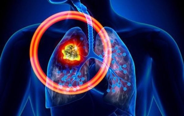 Điều trị ung thư phổi không tế bào nhỏ