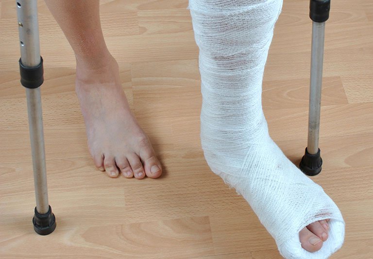 Lời khuyên cho bệnh nhân bị gãy xương chân