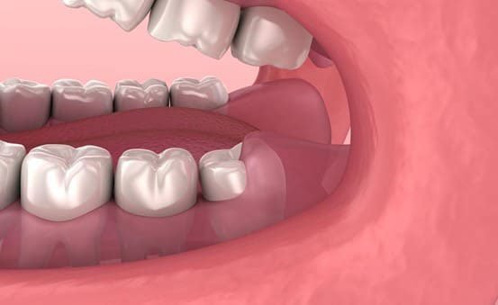 lợi thừa ở răng hàm