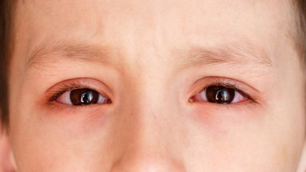 Trẻ 11 tuổi mí mắt khô cần nhỏ thuốc gì?