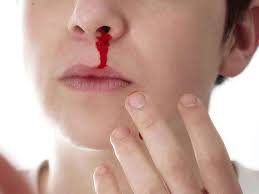 Đau mũi kèm chảy máu mũi kéo dài