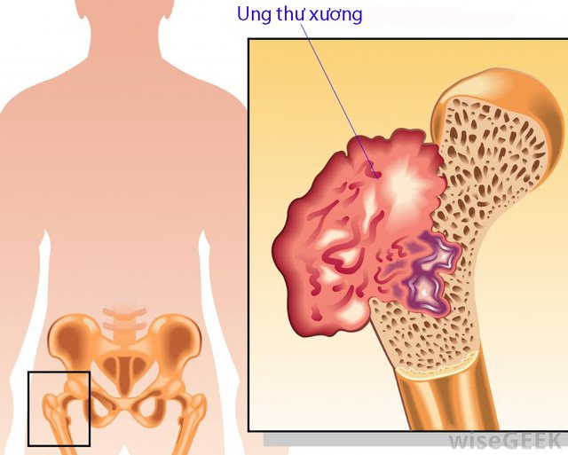 Bệnh nhân ung thư xương chậu ho nhiều kèm tức ngực là bệnh gì?