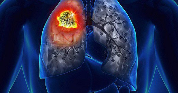 Ung thư phổi hạch trung thất chưa di căn điều trị như thế nào?