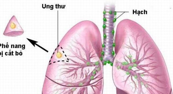 Ung thư phổi tế bào nhỏ di căn hạch cổ điều trị thế nào?